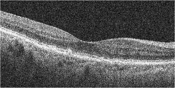 Optical Coherence Tomography | RSIP Vision