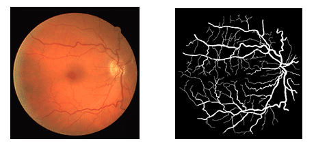Deep Learning for Vessel Segmentation in Fundus Images