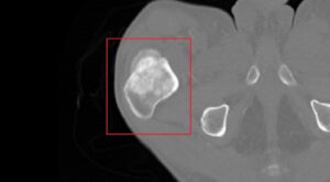 Osteosarcoma