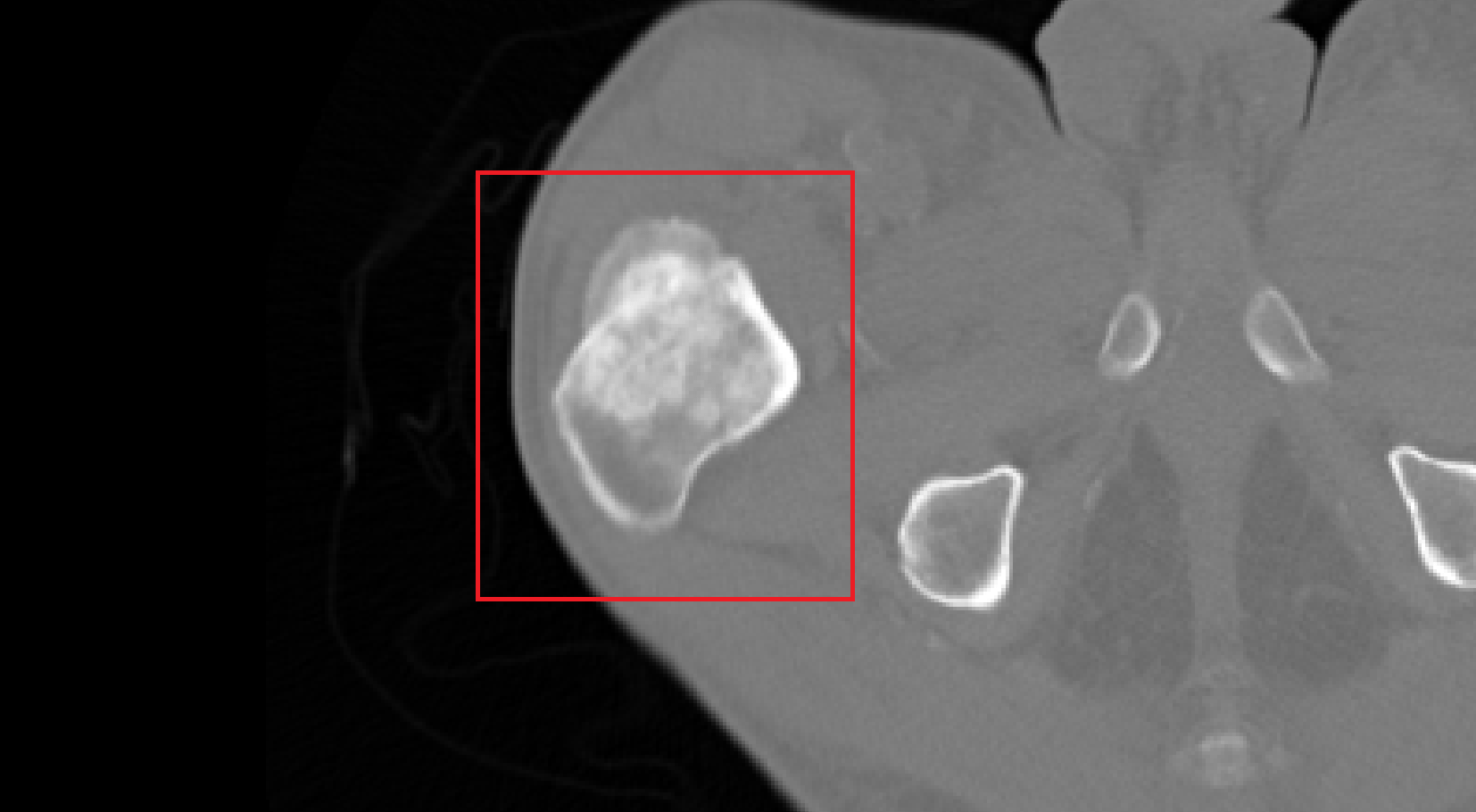 Detection And Quantification Of Primary And Metastatic Bone Cancer