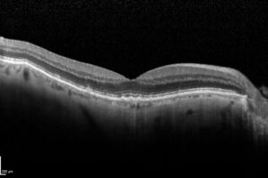 SD-OCT image of Geographic Atrophy