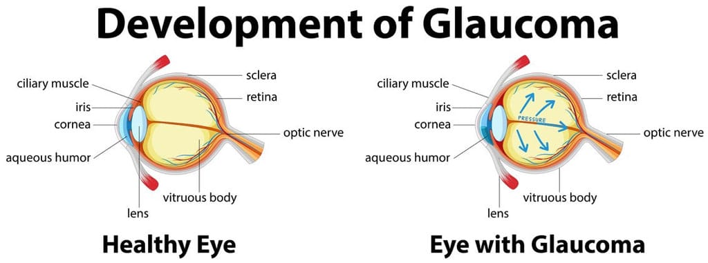 Glaucoma Detection, Damage Assessment Via Deep Learning