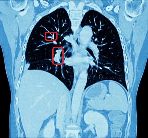 Automated Chest CT Scan Analysis With Deep Learning Classifier