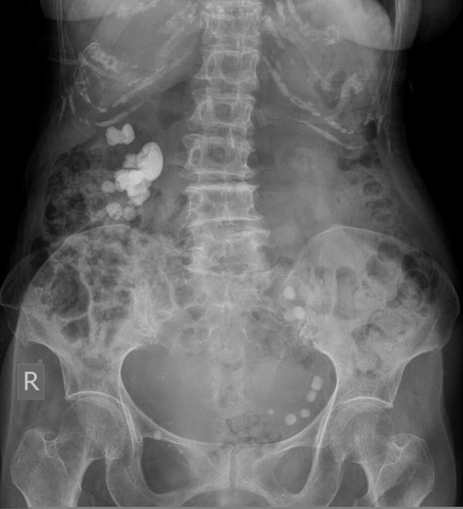 Improved Pcnl With Computer Vision By Rsip Vision